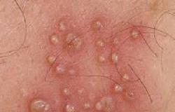 Genital herpes: how it manifests itself in men and women, treatment
